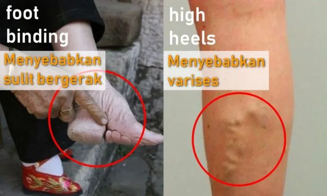 Antara Foot Binding dan High Heels, Perempuan Masih Saja Menyiksa Kakinya Demi Merasa Cantik 18