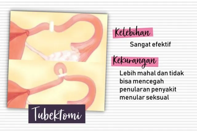 Biar Nggak Buta Sama Pilihan yang Ada, Yuk Kenali 10 Macam Alat Kontrasepsi Ini! 19