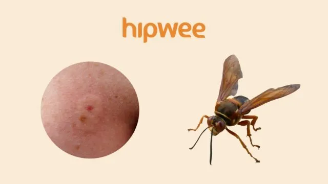 11 Tipe Bekas Gigitan Serangga yang Ada di Sekitar Kita. Biar Lebih Waspada akan Bahayanya 15
