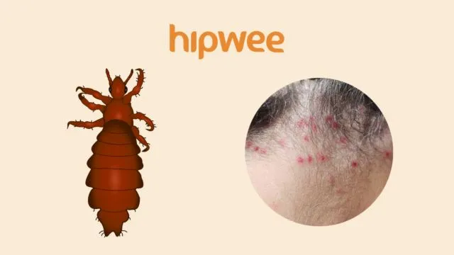 11 Tipe Bekas Gigitan Serangga yang Ada di Sekitar Kita. Biar Lebih Waspada akan Bahayanya 20