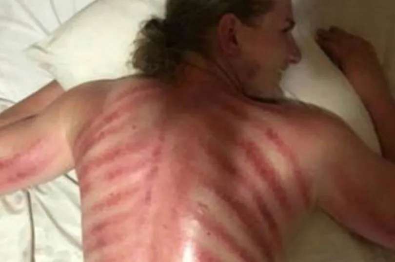 Bule ini Dapati Punggungnya Kena “Red Dragon Massage” Setelah Nyobain Jasa Pijat Via Aplikasi Online