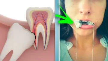 7 Cara Agar Gigi Geraham Bungsu yang Salah Tumbuh Nggak Nyeri Lagi