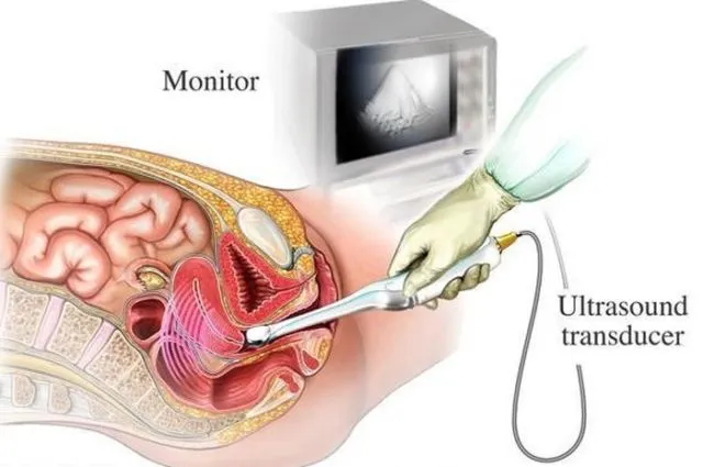 Sama-sama Bisa 'Mengintip' Wajah Janin di Perut, Inilah Bedanya USG 2D, 3D, 4D dan Trans Vaginal 6