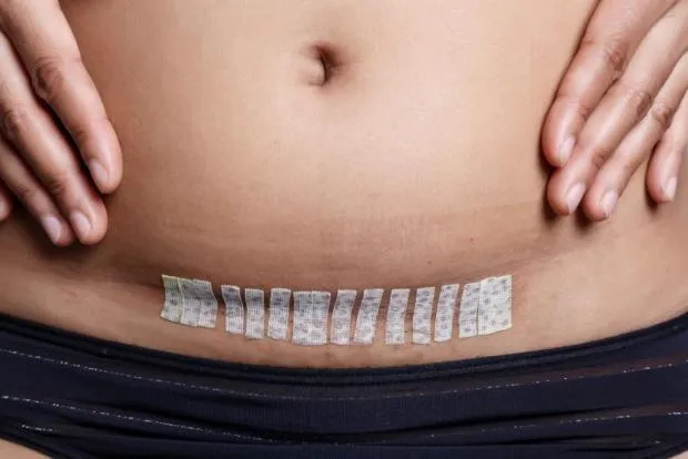 4 Pertimbangan Memilih Persalinan Normal Setelah Melahirkan Sesar. Risikonya Lebih Kecil! 8