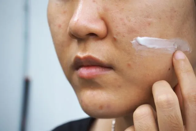 Mengulas Jerawat Pasir yang Suka Datang Keroyokan dan Cara Mengusirnya 13 jerawat pasir