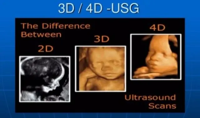 Sama-sama Bisa 'Mengintip' Wajah Janin di Perut, Inilah Bedanya USG 2D, 3D, 4D dan Trans Vaginal 8