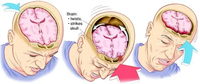 5 Pemicu Penyakit Stroke di Usia Muda. Sering Migrain Salah Satunya 9 stroke di usia muda