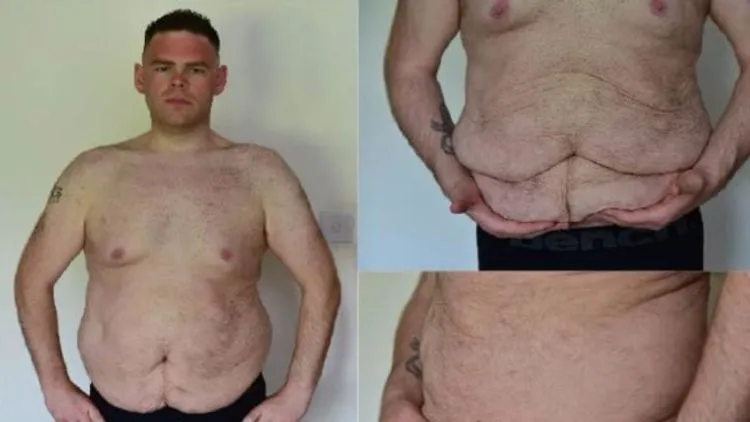 Perjuangan Arya Lawan Obesitas. Berhasil Turunkan Berat Badan, Begini Penampakannya Saat Ini 4