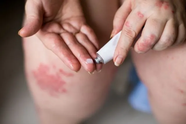 Tentang Psoriasis, Penyakit Kulit yang Diderita Kim Kardashian ini Kabarnya Belum Ada Obatnya 10