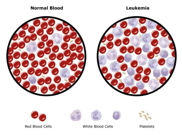 6 Info Tentang Kanker Darah yang Simpang Siur. Kanker Darah = Leukimia? 7 fakta kanker darah