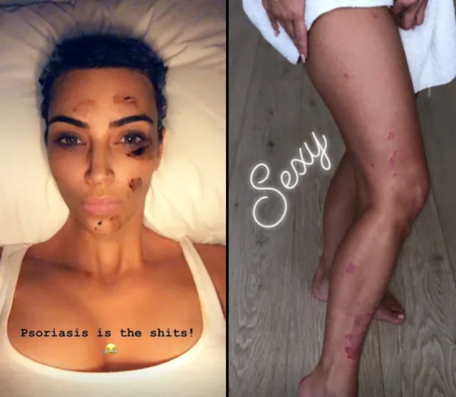 Tentang Psoriasis, Penyakit Kulit yang Diderita Kim Kardashian ini Kabarnya Belum Ada Obatnya 6