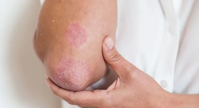 Tentang Psoriasis, Penyakit Kulit yang Diderita Kim Kardashian ini Kabarnya Belum Ada Obatnya 9
