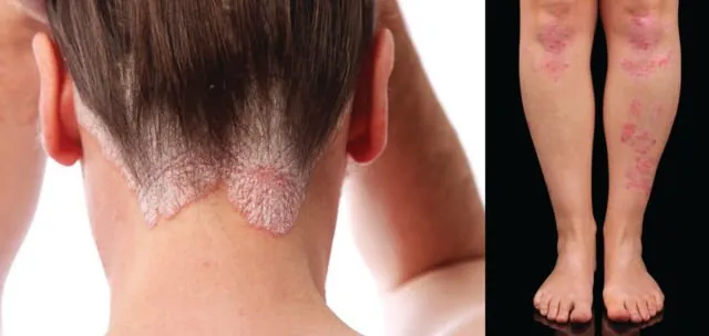 Tentang Psoriasis, Penyakit Kulit yang Diderita Kim Kardashian ini Kabarnya Belum Ada Obatnya 7