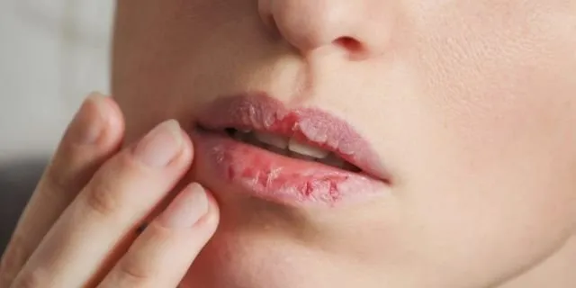 5 Penyebab Tak Terduga Kenapa Bibirmu Jadi Hitam Selain Merokok 6 penyebab bibir hitam