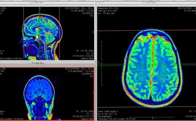 Hasilnya Sama-Sama Mirip Foto Klise hitam Putih, ini Bedanya X-Ray, CT Scan, dan MRI 11