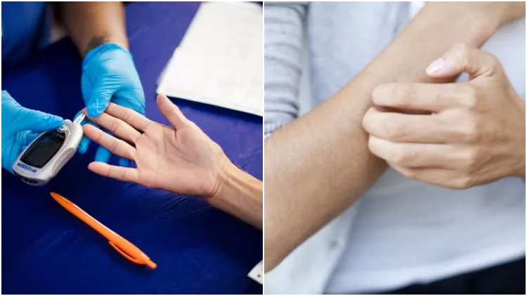 Bedanya Diabetes Kering dan Basah Menurut Medis. Lebih Parah yang Mana sih Sebenarnya?