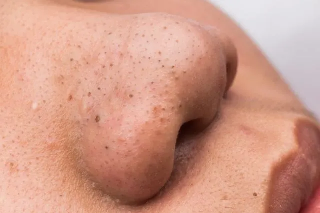 7 Fakta Pore Pack yang Justru Sering Dibilang Bikin Komedo, Benarkah? 10