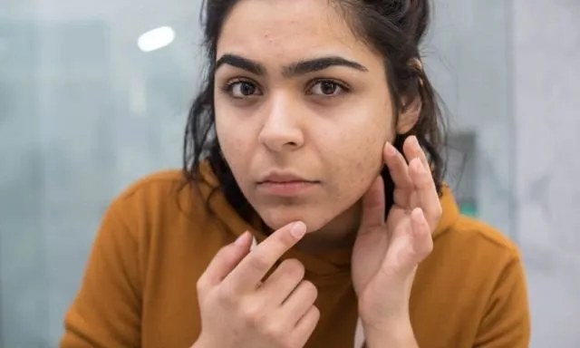 Apa itu Fungal Acne? Pengertian dan Cara Mengatasinya 8