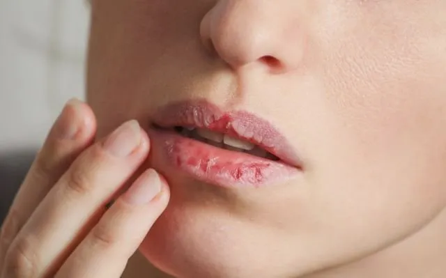 6 Khasiat Madu untuk Bibir, Jadi Pengganti Lip Balm! 8