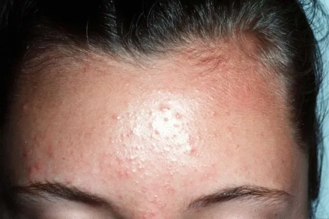 Apa itu Fungal Acne? Pengertian dan Cara Mengatasinya 6