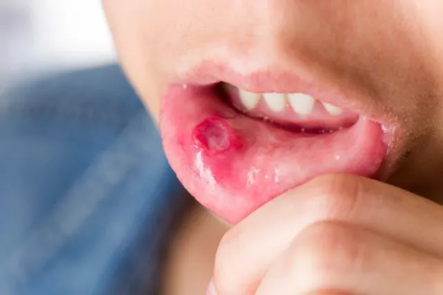 6 Khasiat Madu untuk Bibir, Jadi Pengganti Lip Balm! 10