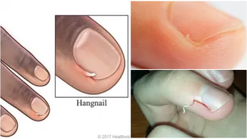 Cara Mengatasi Hangnail, Kulit Lancip yang Sering Nongol di Dekat Kuku Jari Tangan atau Kaki