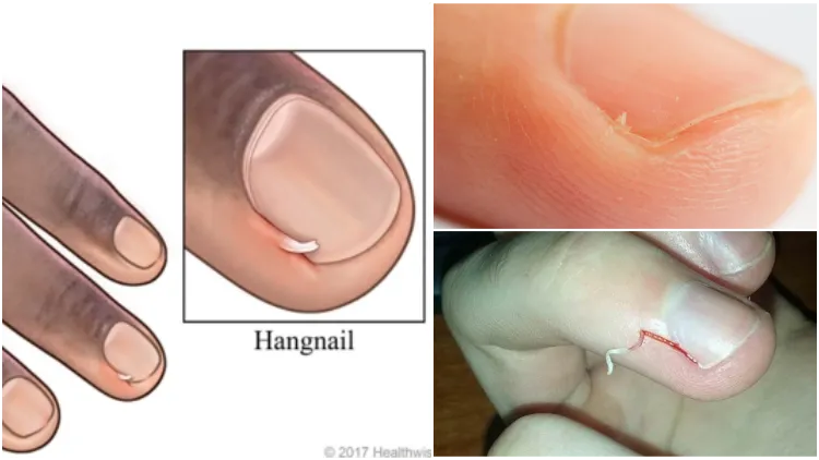 Cara Mengatasi Hangnail, Kulit Lancip yang Sering Nongol di Dekat Kuku Jari Tangan atau Kaki