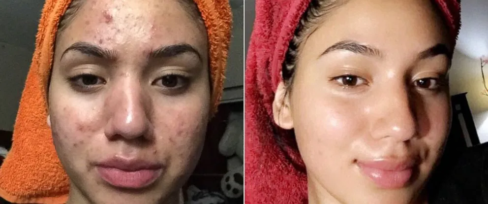 6 Manfaat Jeruk Nipis yang Nggak Sekadar Ngilangin Bau Amis. Rugi Banget Kalau Nggak Digubris 8