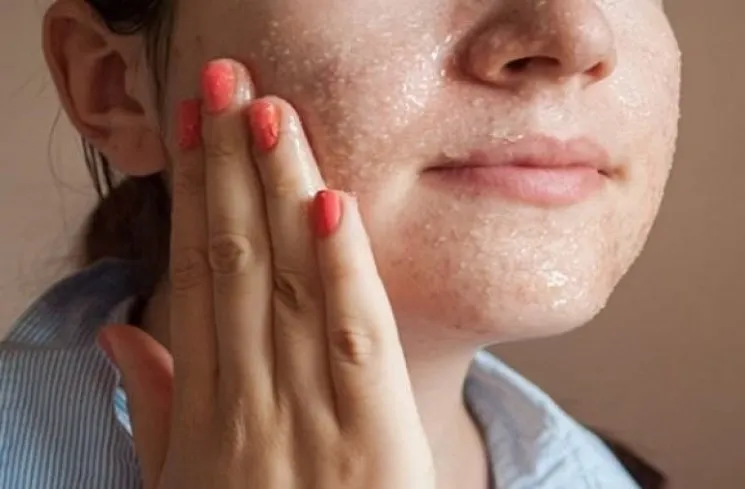 Cara Menghilangkan Komedo yang Membandel di Hidung Hingga Pipi, Baik yang Hitam Maupun Putih 30