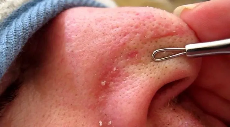 Cara Menghilangkan Komedo yang Membandel di Hidung Hingga Pipi, Baik yang Hitam Maupun Putih 19