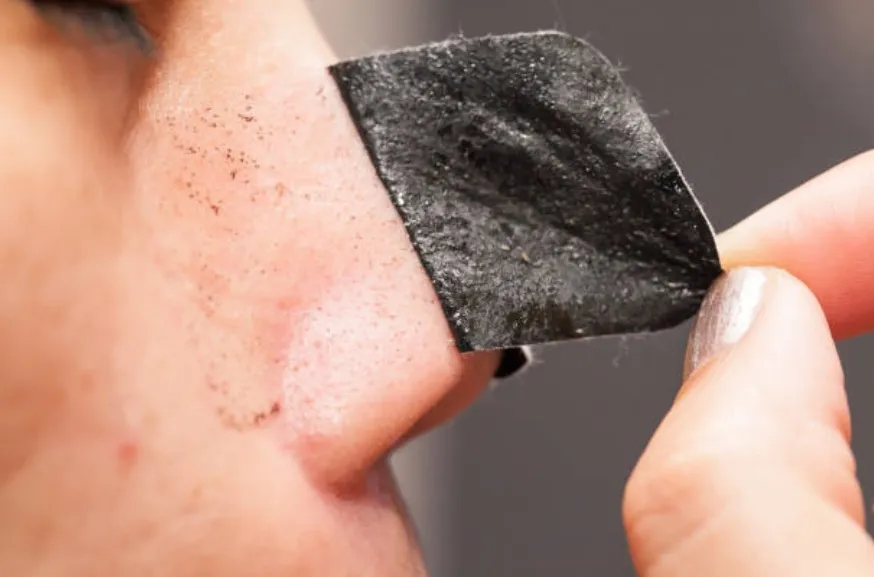 Cara Menghilangkan Komedo yang Membandel di Hidung Hingga Pipi, Baik yang Hitam Maupun Putih 25