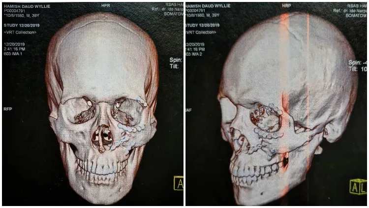 Sempat Trauma karena Kecelakaan, Hamish Daud Unggah Foto X-Ray Wajahnya. Ternyata Penuh Baut 4