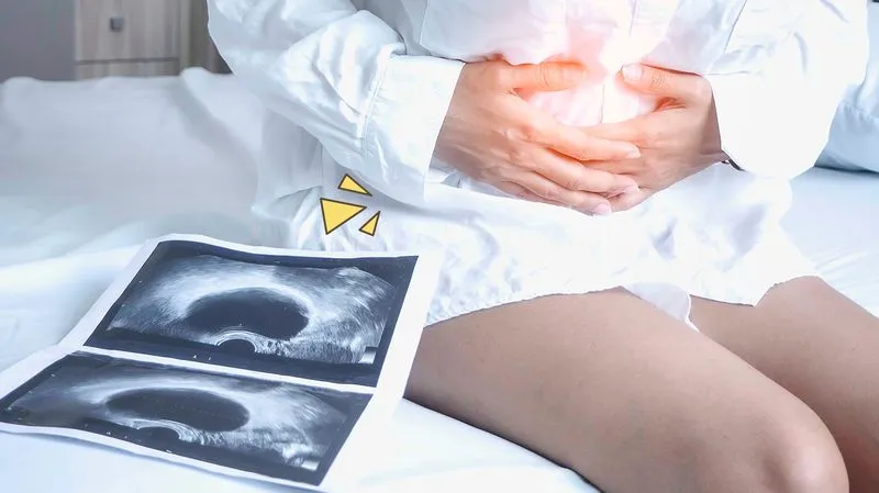 Penyebab Kram Perut Berdasarkan Letak Keluhannya. Nyeri di Perut Atas dan Bawah Jelas Beda 23