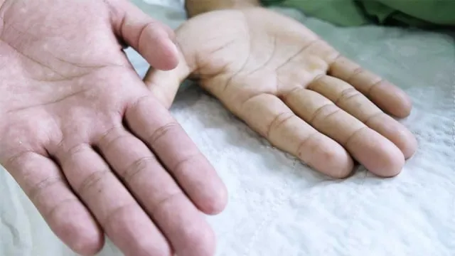 Macam-macam Gejala Anemia, Demen Ngunyah Es Batu Salah Satunya. Kamunya Aja yang Nggak Sadar 13