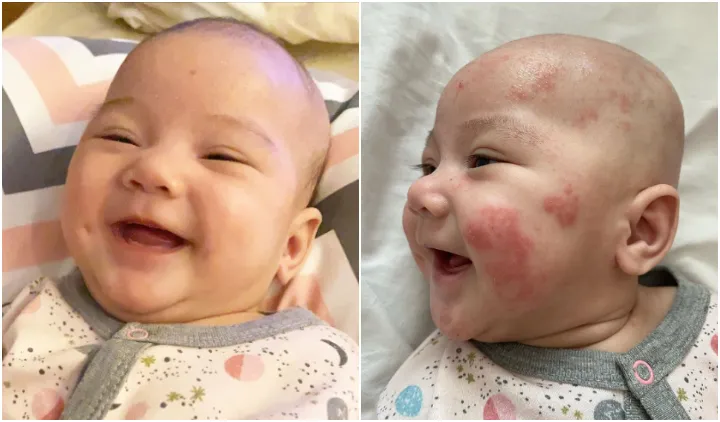 Alami Dermatitis Atopik, Wajah Bayi Mona Ratuliu Dipenuhi Ruam Merah. Sang Ibu Putuskan Diet Sehat 3