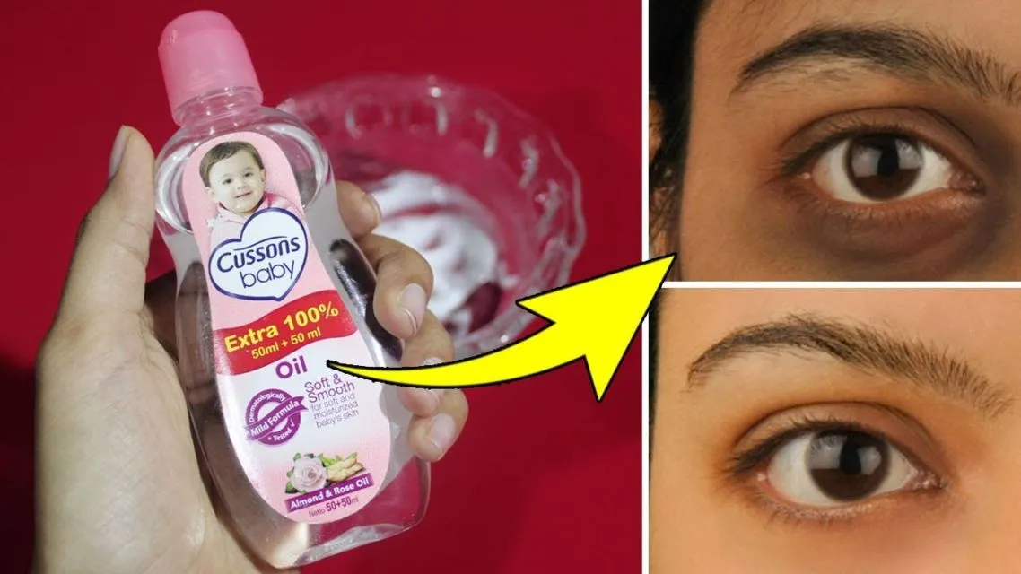 7 Cara Menghilangkan Kantung Mata dengan Bahan Alami, Nggak Perlu Makeup! 14 cara menghilangkan kantung mata