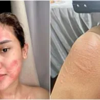 Alami Kulit Gatal Kemerahan Selama 5 Tahun Terakhir, Cita Citata Ternyata Alami Peradangan Amandel