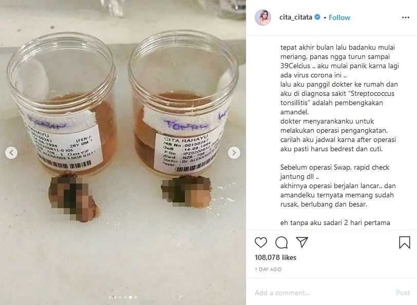 Alami Kulit Gatal Kemerahan Selama 5 Tahun Terakhir, Cita Citata Ternyata Alami Peradangan Amandel 4
