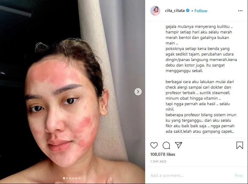 Alami Kulit Gatal Kemerahan Selama 5 Tahun Terakhir, Cita Citata Ternyata Alami Peradangan Amandel 3