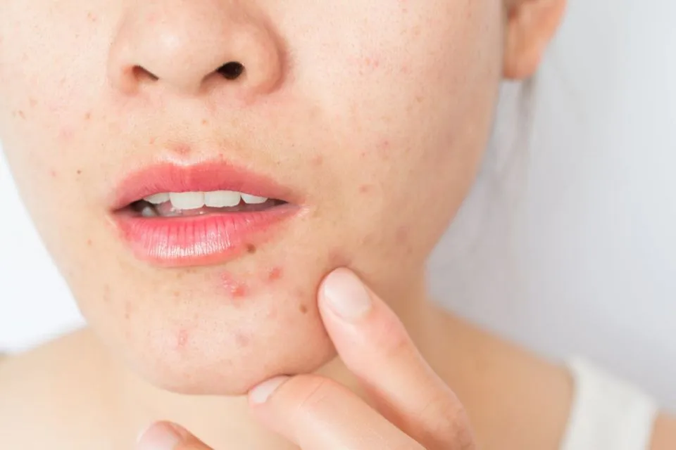 6 Efek Samping Penggunaan Toner Cuka Apel yang Kurang Tepat 10