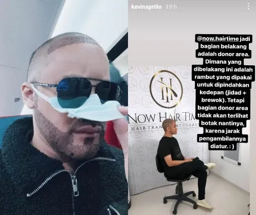 Tampil dengan Kepala Plontos, Kevin Aprilio Jalani Transplantasi Rambut. Akui Insecure 2