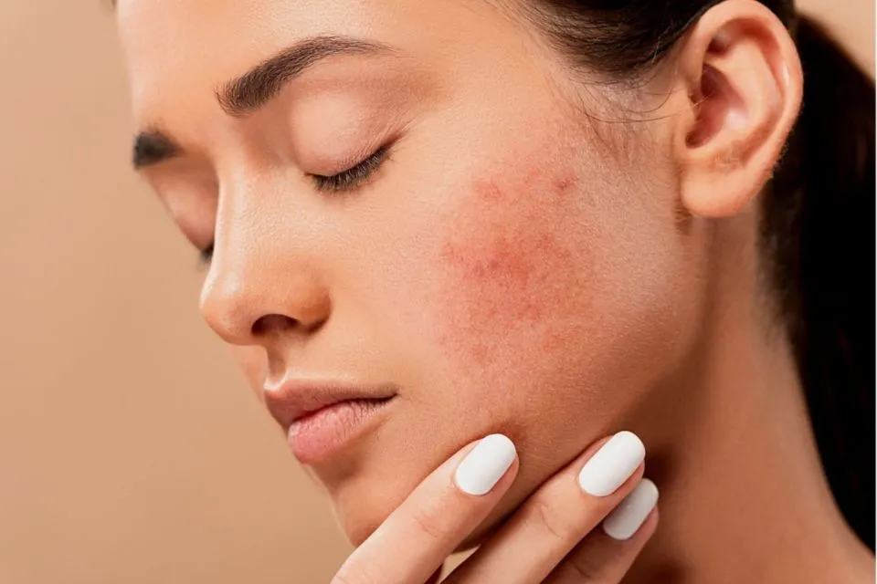 Maskne, Fenomena Muncul Jerawat Gegara Pakai Masker. Gini Cara Cegah Plus Atasinya! 6