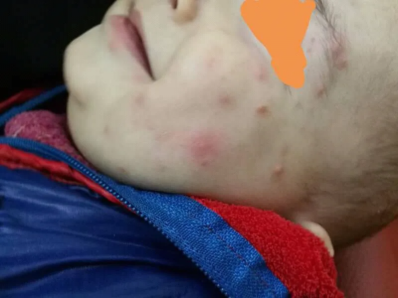 Perbedaan Kadas, Kurap dengan Panau ataupun Kudis 6 perbedaan kurap dan kudis