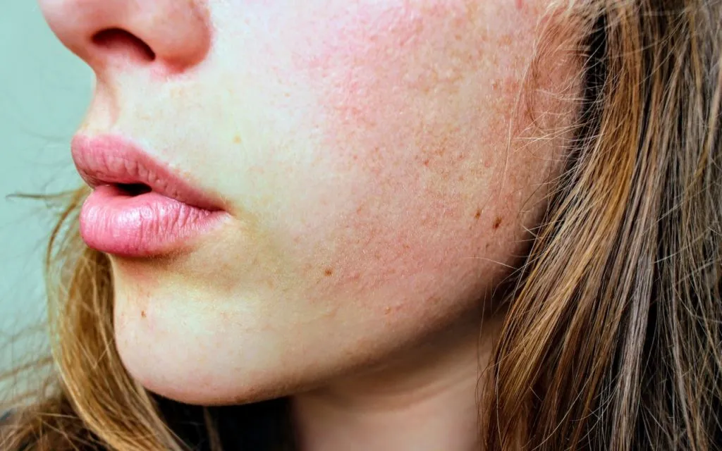 Tips Menjaga Kesehatan Skin Barrier, Kenali juga Penyebab Kerusakannya 4