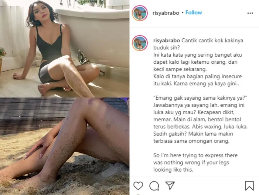 Kaki Banyak Luka Dibilang Budukan, Selebgram Risya Brabo: Nggak Ada yang Salah dengan itu 2