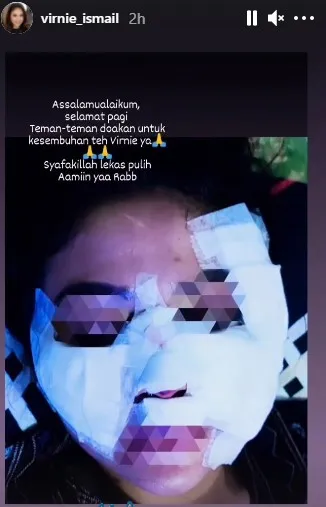 Virnie Ismail Kecelakaan Saat Bersepeda Sampai Alami Luka Cukup Parah 2