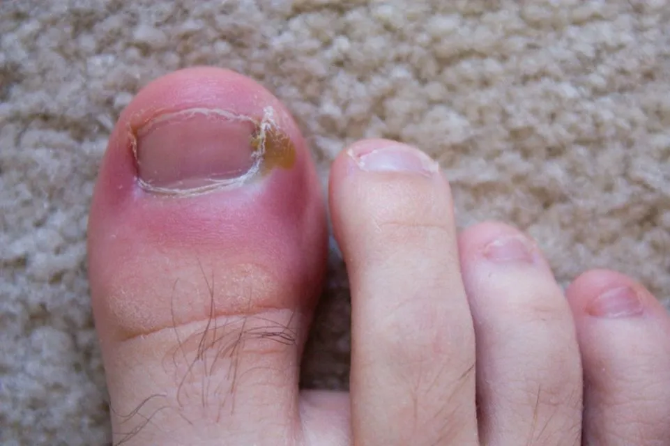 7 Penyakit Kuku Tangan dan Kaki Serta Penyebabnya. Awas, Bisa Bahaya! 12 Penyakit kuku