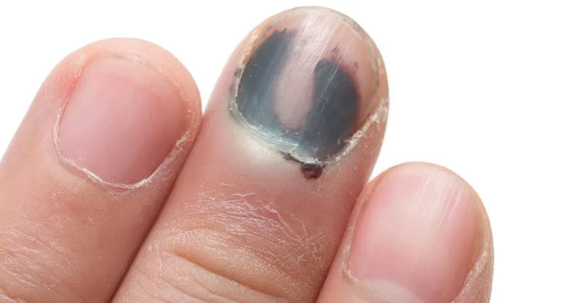 7 Penyakit Kuku Tangan dan Kaki Serta Penyebabnya. Awas, Bisa Bahaya! 10 Penyakit kuku