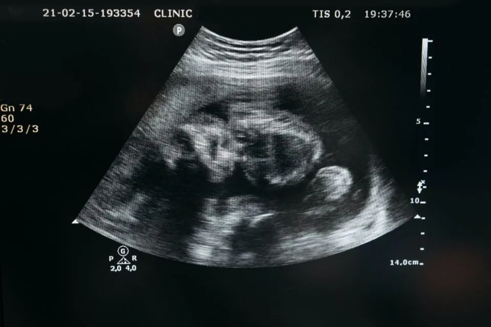 Meski Berpeluang Besar, Ini 6 Risiko yang Mungkin Didapat dari Program Bayi Tabung 8