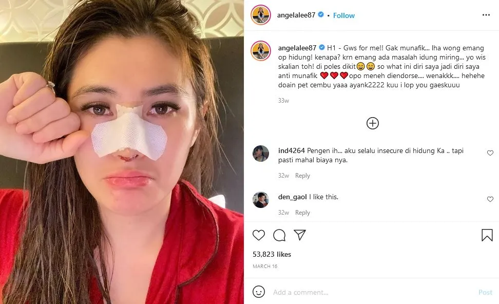 Implan Hidung Bocor, Angela Lee Menyesal Lakukan Operasi. Ingatkan Publik untuk Lebih Hati-Hati 2